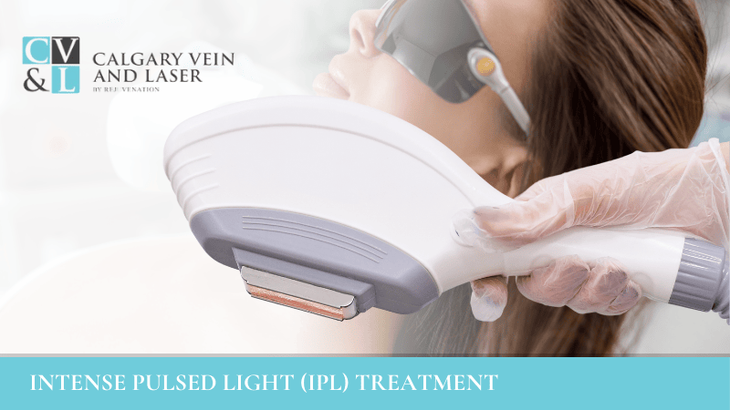 IPL Treatments in Calgary | Calgary Vein & Laser Clinic
